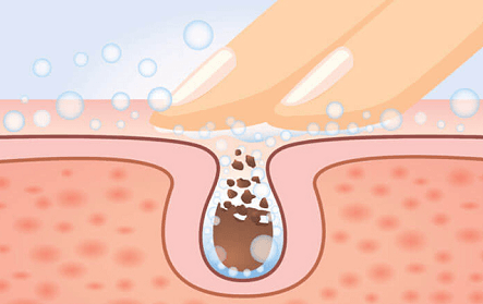 如何預防毛孔堵塞？高效護膚技巧完整教學