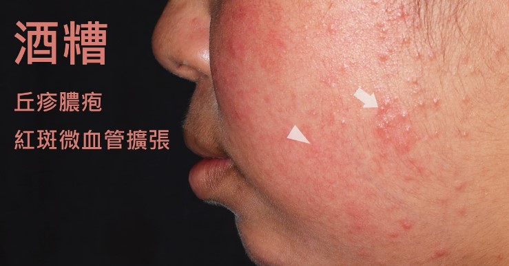 酒糟肌必讀！避開敏感地雷，告別紅腫灼熱