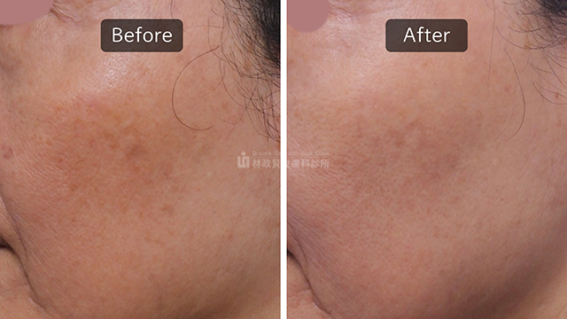 如何高效改善因空氣污染導致的膚色暗沉：專業皮膚科醫師的完整教學