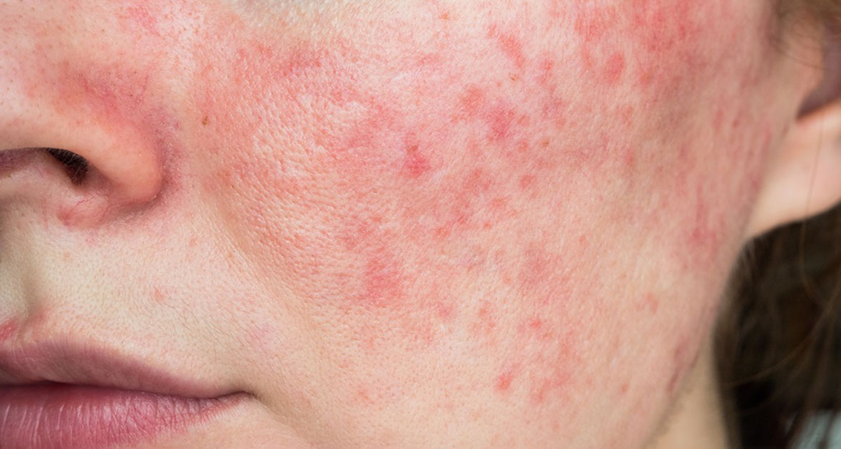 如何知道自己是不是酒糟肌？酒糟肌診斷指南：面部紅斑、血管擴張與紅腫膿皰