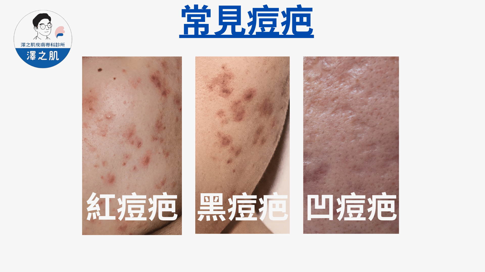 痘疤淡化的最佳護膚方案：凹陷型與色素型痘疤的完整淡化攻略