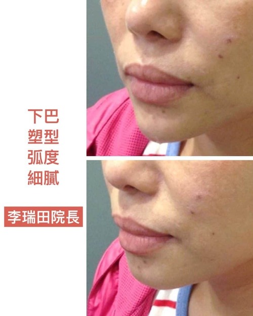 玻尿酸填充術後保養：防止腫脹與推移的小秘訣！薇薇安醫師完整教學