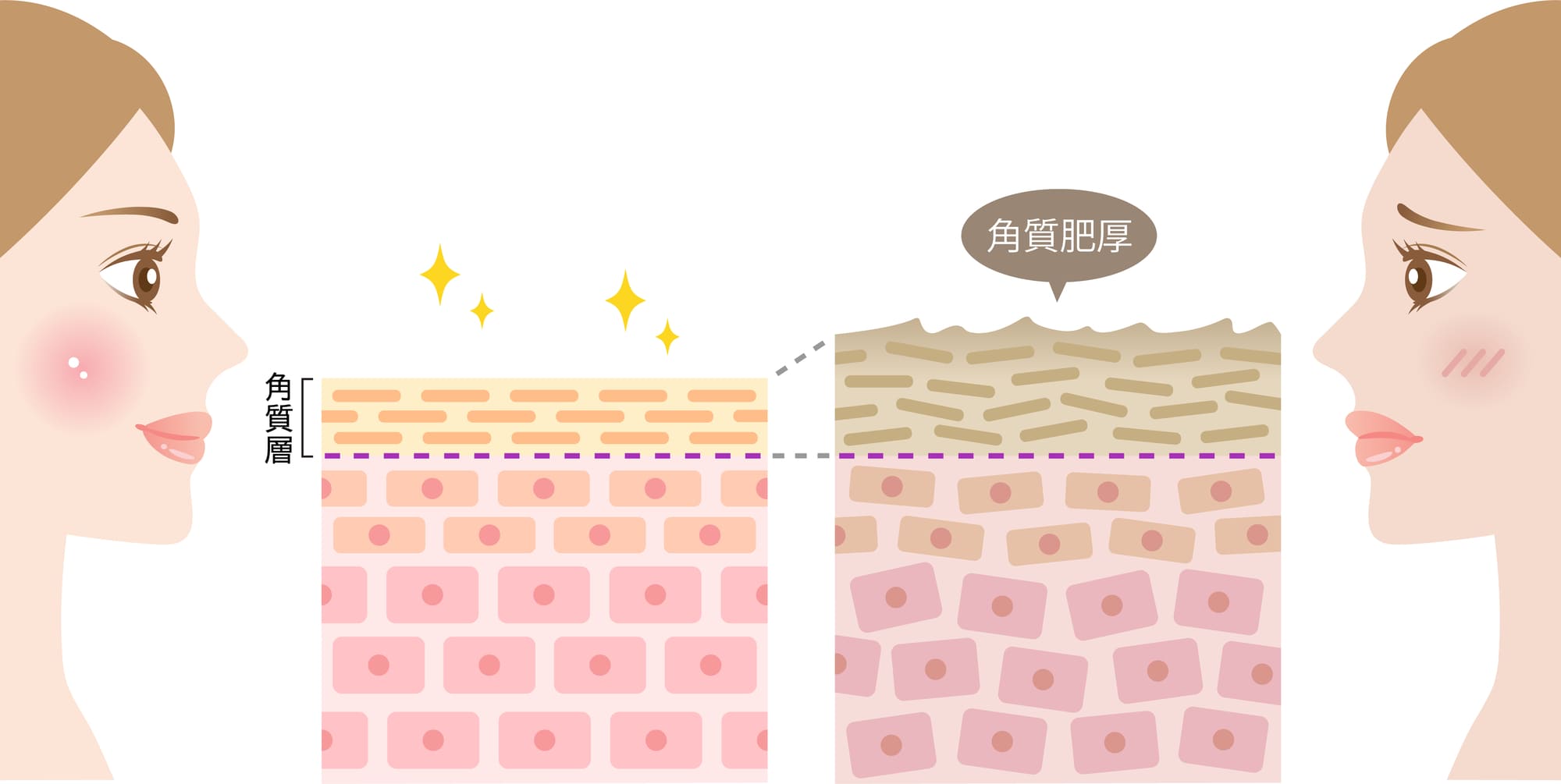 肌悩み別！スキンケア製品に含まれるピーリング成分の選び方と効果的な使い方