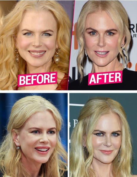 肉毒桿菌注射後臉部修護：降低僵硬與不自然感的關鍵攻略