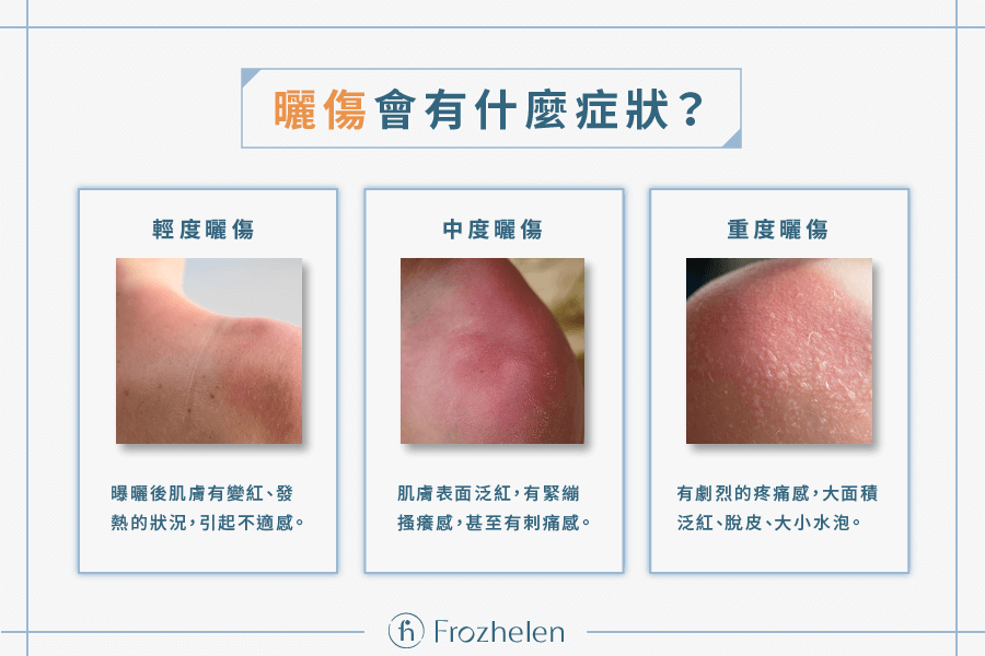 曬傷退紅會變黑嗎？皮膚科醫生教你高效預防曬後色素沉澱！