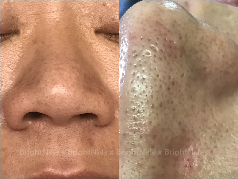 臉油怎麼洗？2招速吸油光！重點是生活改善