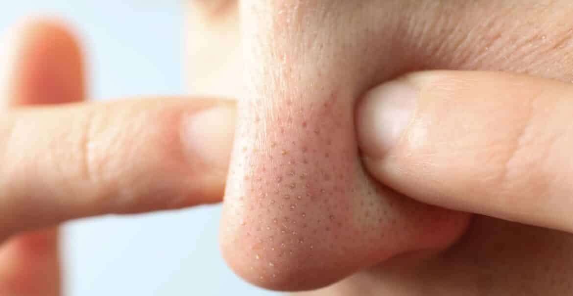 鼻翼毛孔粗大該如何改善？皮膚科醫生助理的完整護理攻略