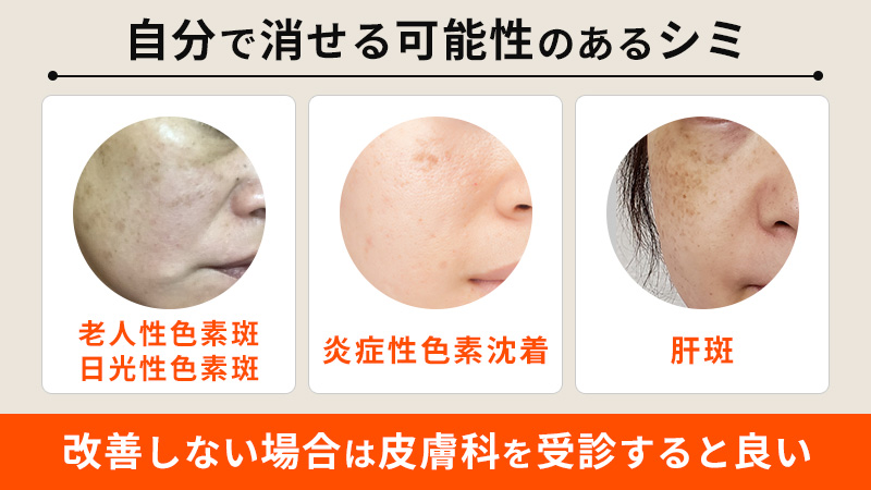 シミ対策の秘訣！スキンケア製品で色素沈着を軽減する方法