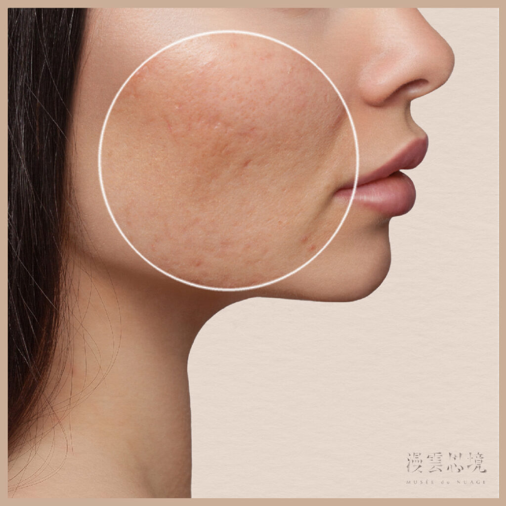 毛孔粗大保養品指南：從醫美角度解析縮小毛孔秘方