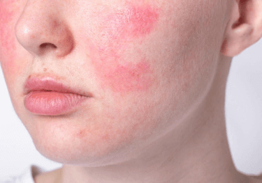 皮膚屏障受損擦什麼？高效修復指南：預防與改善肌膚乾燥、敏感問題