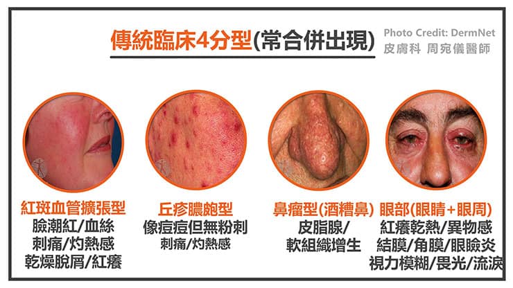 酒糟無法根治嗎？控制病情、揮別酒糟困擾的秘密