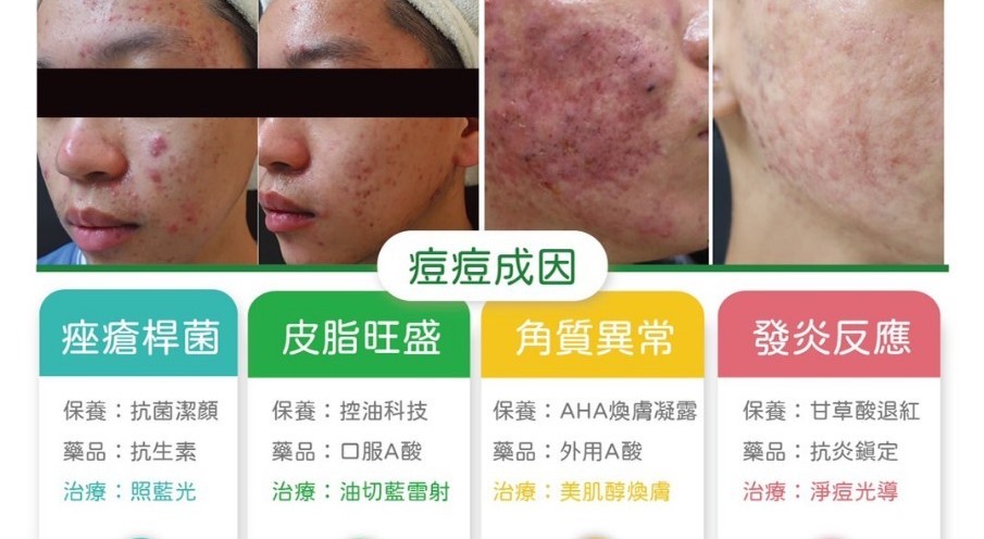 控油護膚技巧完整教學：告別油光痘痘，找回自信美肌