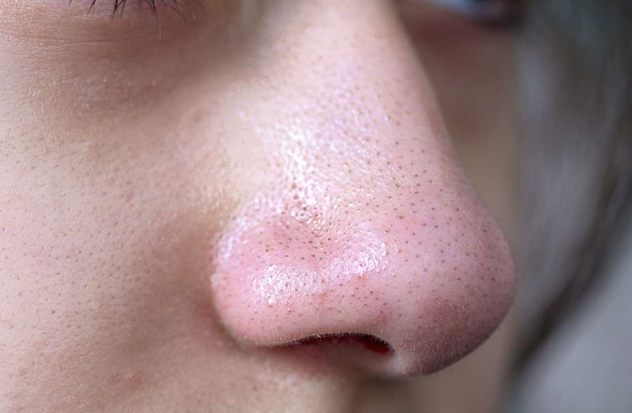 黑頭粉刺怎麼清？一次搞懂形成原因與去除方法