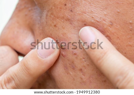 A醇痘疤修復效果必看！林醫師完整教學：凹洞、色素沉澱都有效，必學攻略！