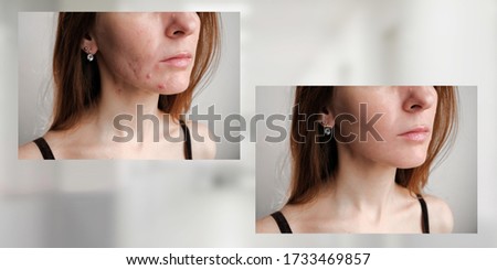 下巴長了硬硬的「囊腫痘痘」怎麼辦？皮膚科醫師教你有效應對與護理