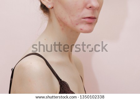 戰勝黑頭粉刺！油性肌膚控油的關鍵步驟