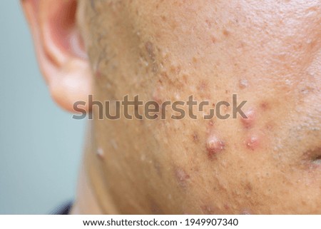 上嘴唇長痘痘？小心是唇皰疹！如何辨別與預防傳染風險？