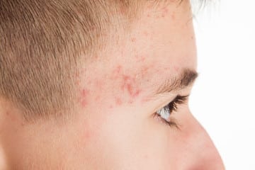 戰勝「痘界釘子戶」！閉鎖性粉刺專業根治指南