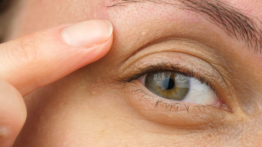 眼周白色小顆粒是肉芽還是粉刺？粟粒腫成因與無痛清除方法