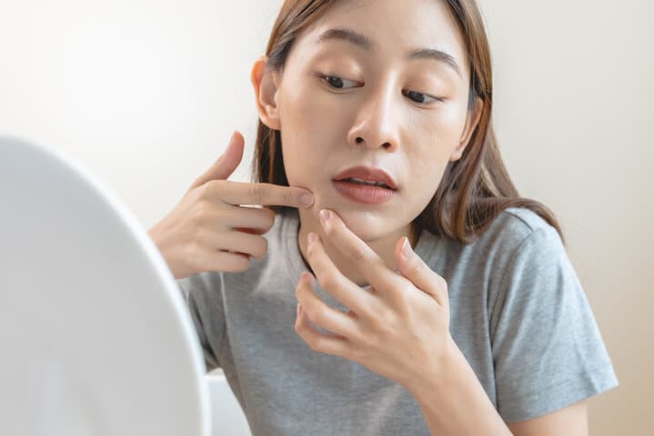 我的粉刺是「黑頭」還是「閉鎖性」？不同類型的粉刺，需要不同的處理策略