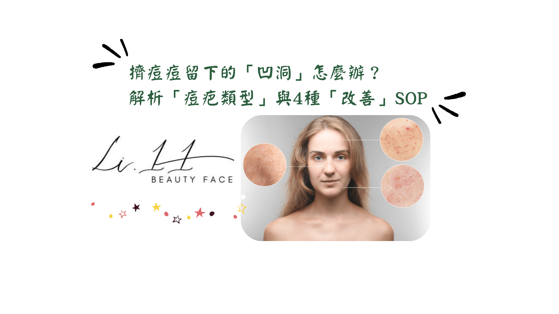 擠痘痘留下的凹洞怎麼辦？專業美容師解析痘疤類型與4種改善SOP