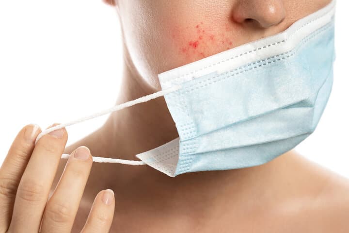 林口口罩痘改善全攻略：下巴痘痘反覆長是內分泌還是悶熱？專業皮膚管理建議