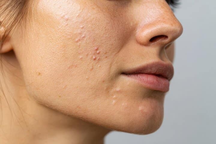 生理痘長不停？經前爆痘怎麼辦？配合「生理週期」的林口做臉護理建議