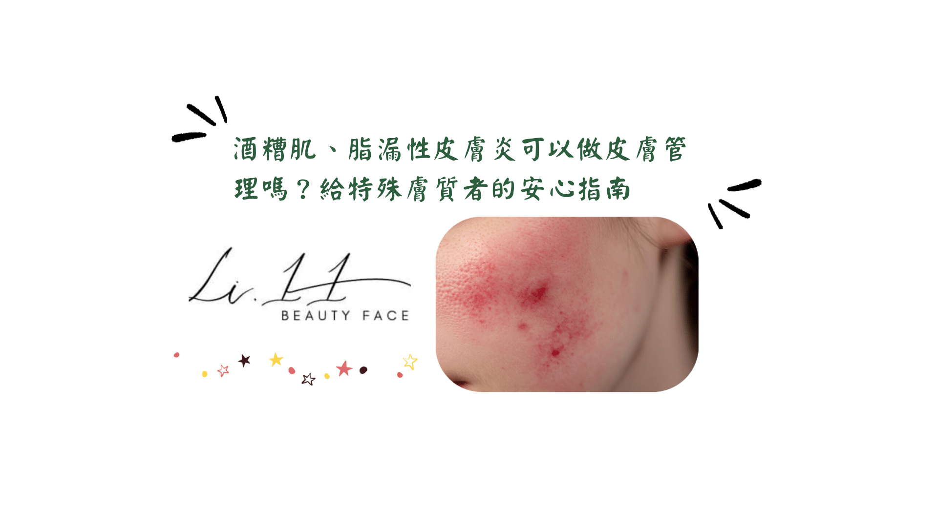 酒糟肌、脂漏性皮膚炎，可以做皮膚管理嗎？給特殊膚質者的安心指南