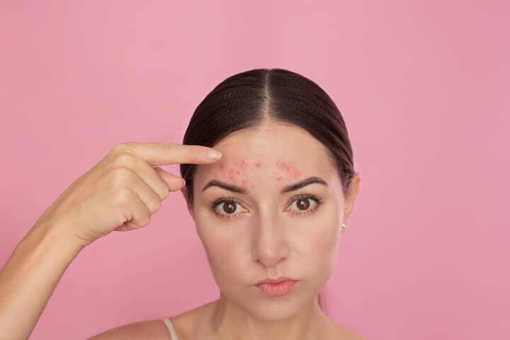 壓力痘、失眠肌如何快速急救？資深美容師的「72小時SOP」：從「痘痘位置」全解析