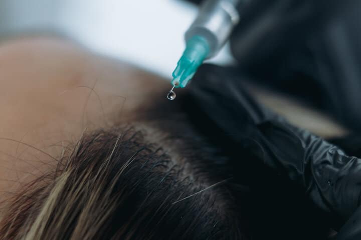 頭皮屑問題根本解決之道與外泌體調理關係｜專業養毛師揭秘革命性治療技術