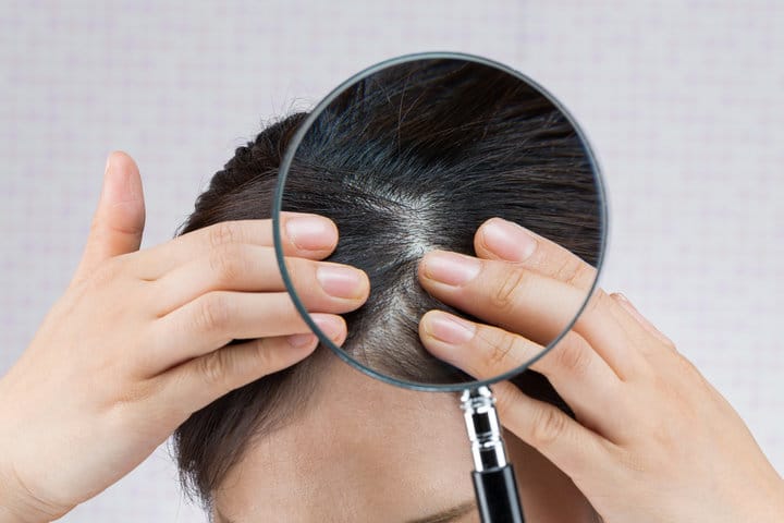 頭皮健康5大關鍵指標｜告別頭皮屑與出油困擾