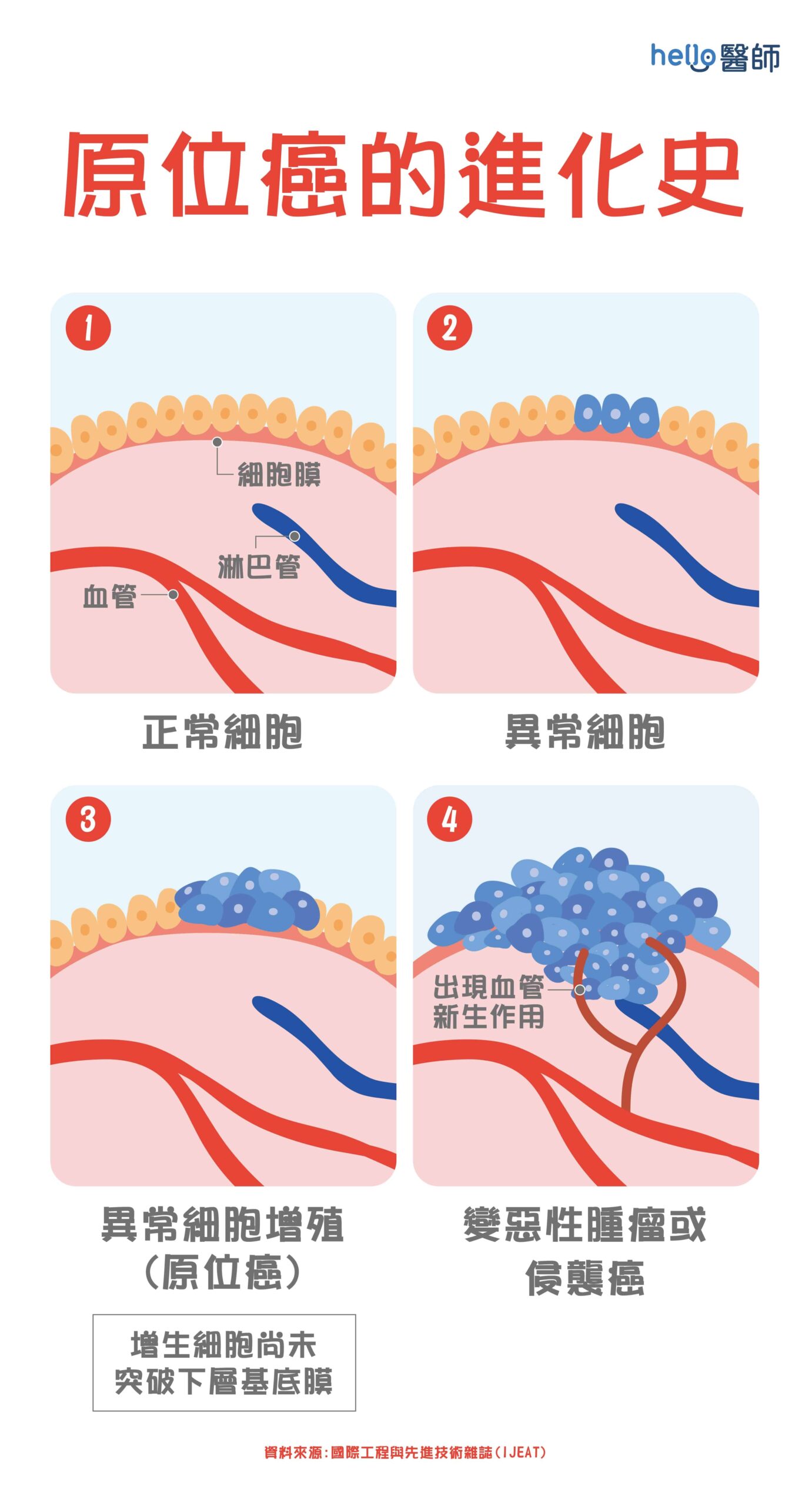 原位癌不算是重大疾病？醫師詳解原位癌的定義、治療與預後