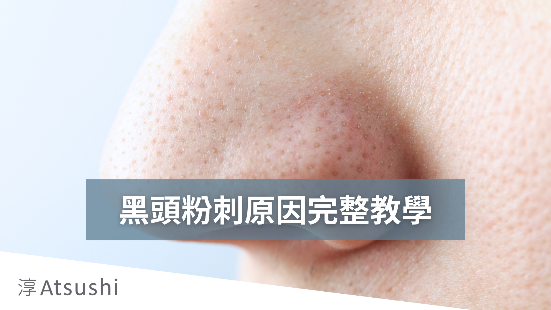 如何處理化妝後的粉刺問題？ 十年皮膚科美容師的完整教學與高效解決方案