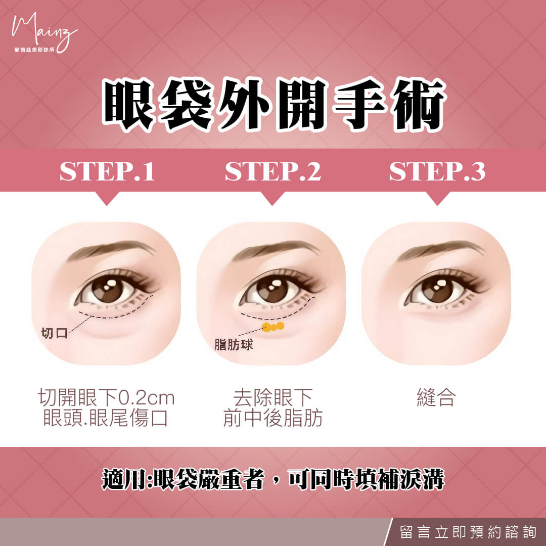 如何針對眼袋問題設計護理方案？皮膚科醫生教你高效解決眼袋困擾！