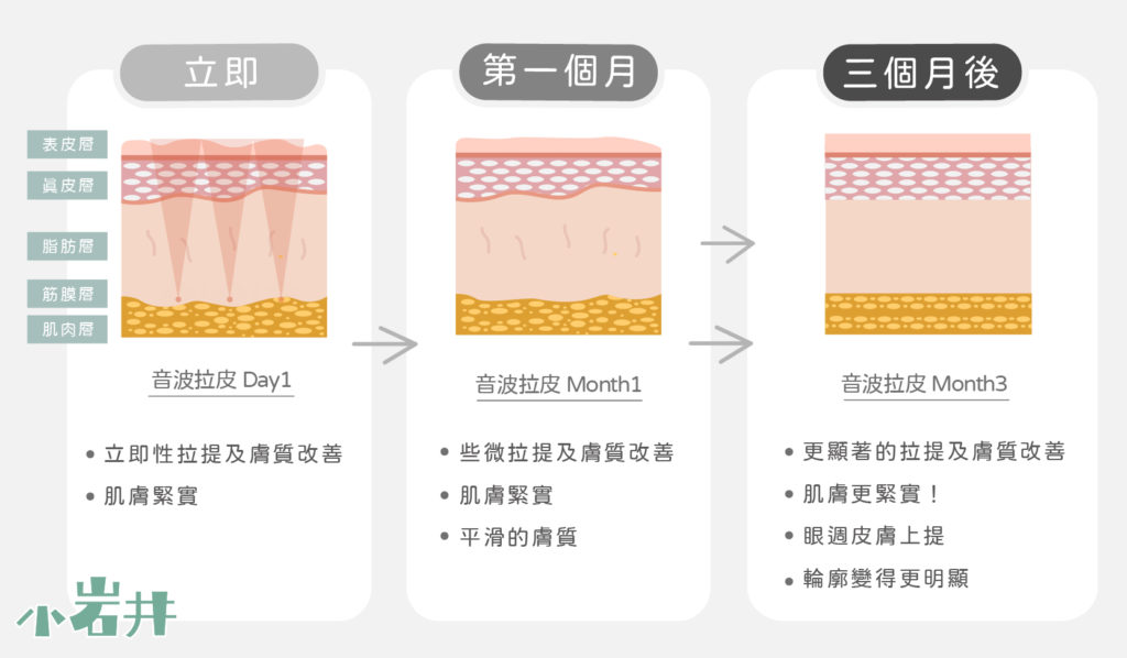 電波拉提術後鎖水保養：維持緊緻曲線的完整攻略！必學保濕秘訣與防曬重點