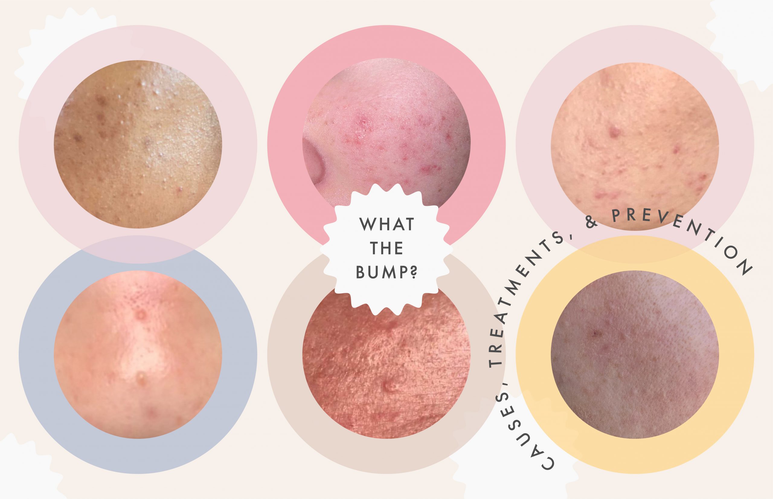 How to Prevent Clogged Pores: A Complete Guide