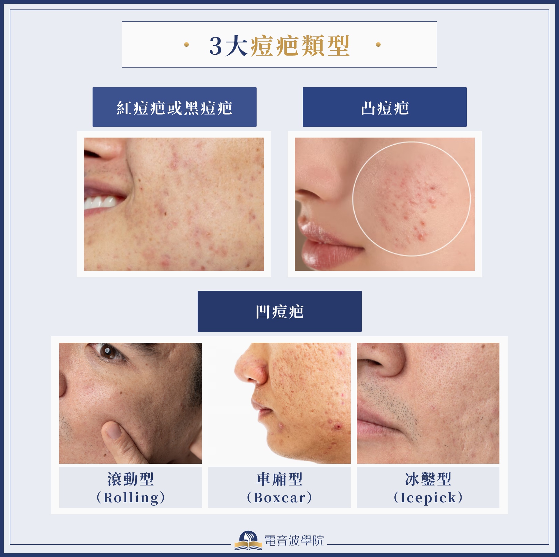 痘疤淡化的最佳護膚方案：完整教學，告別凹陷與色素痘疤！