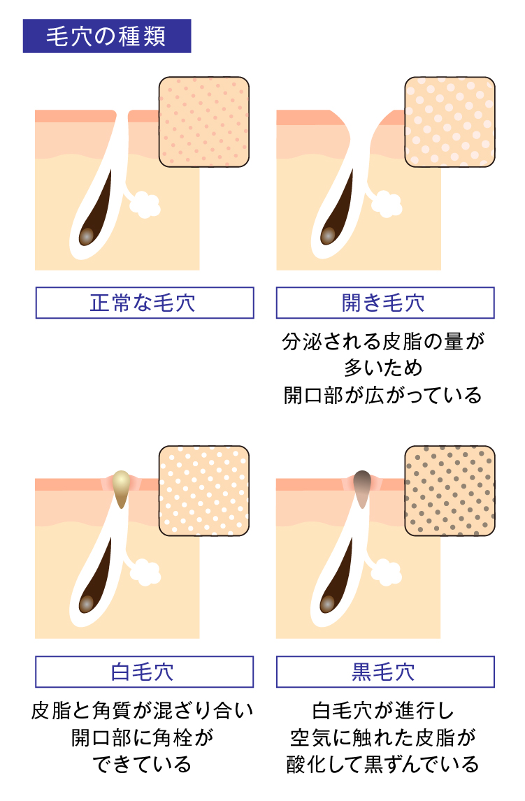 毛穴詰まりを防ぐスキンケア方法：医師が教える美肌への効率的攻略法