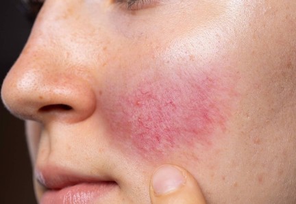 如何利用溫和護膚品改善泛紅現象？敏感肌泛紅急救指南！