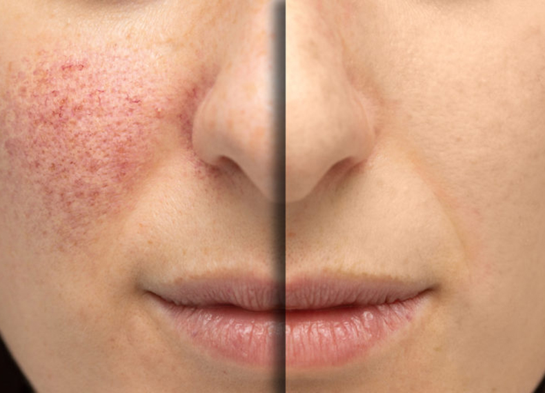 敏感肌の赤み解消！スキンケアで肌の赤みを軽減する方法