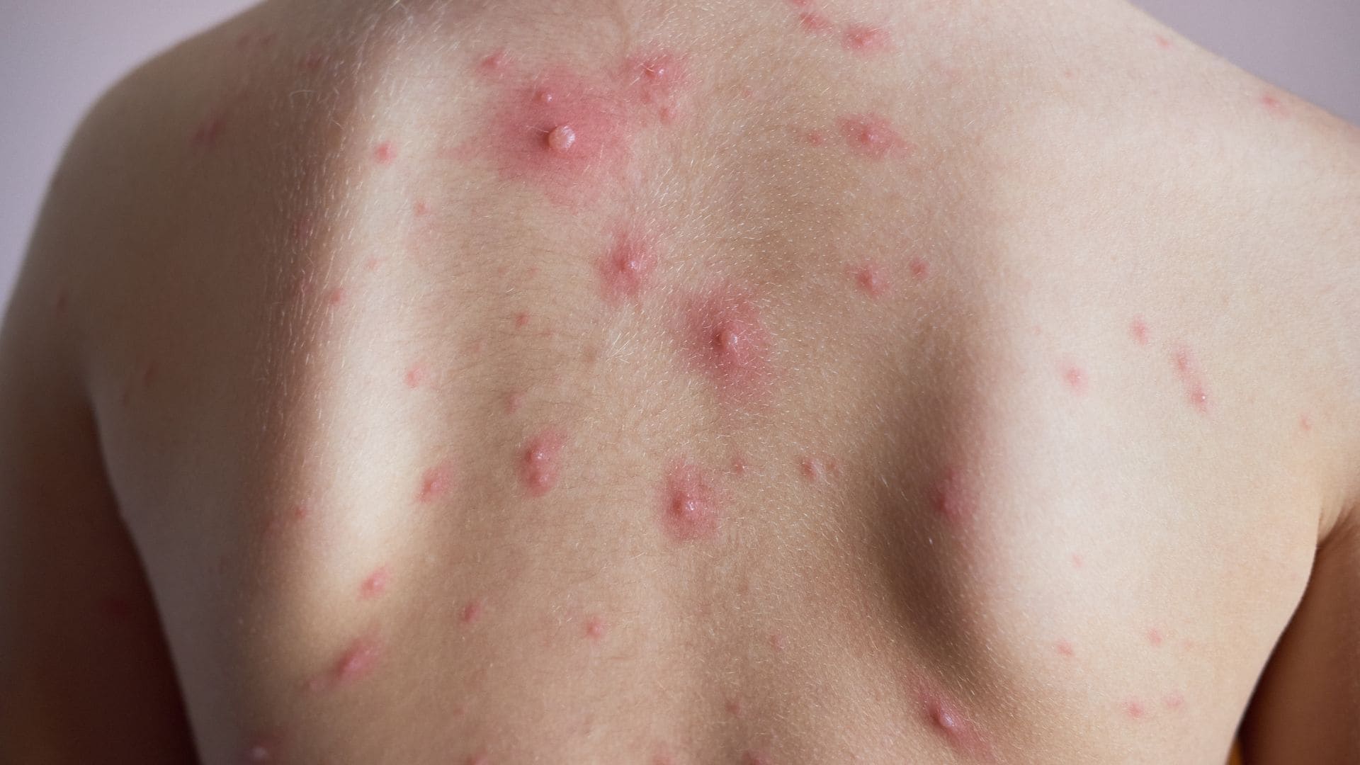 背部痘痘反覆出現的原因與治療重點：醫師親授全方位攻略，擺脫痘痘困擾！