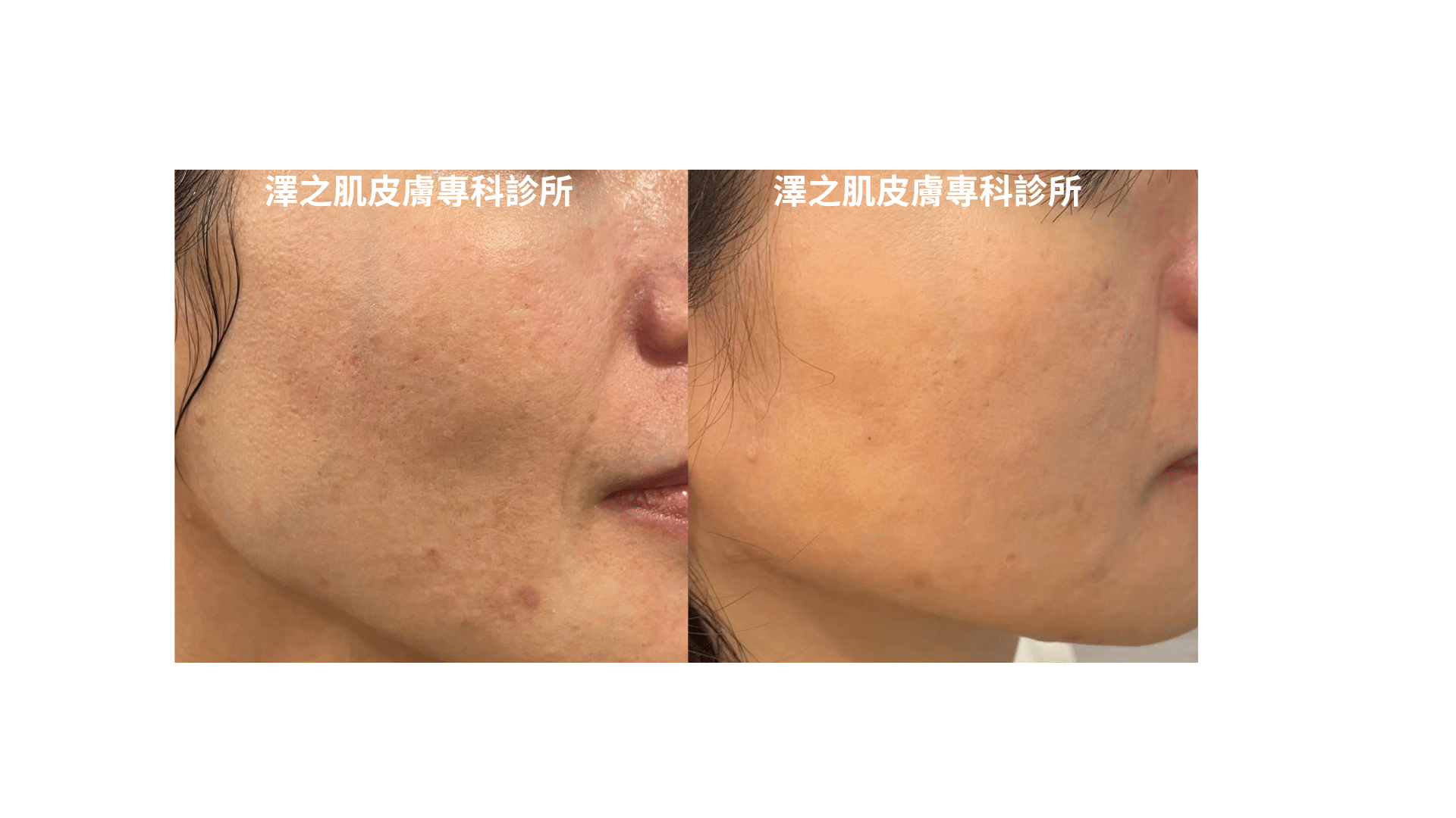 如何改善肌膚粗糙的問題？皮膚科醫生完整教學，告別粗糙肌膚！