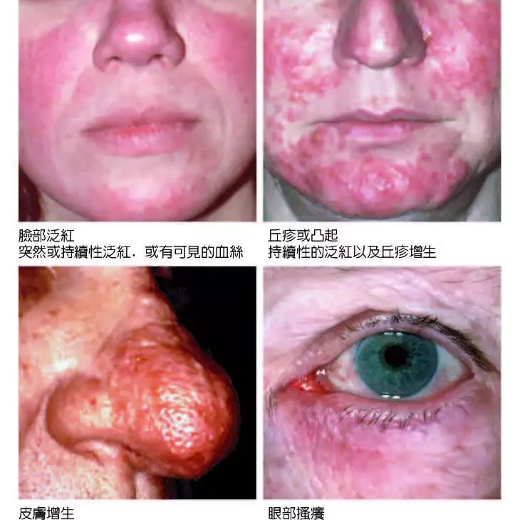 酒糟性皮膚炎與痘痘差在哪？症狀辨別與治療方式一次看！必學攻略！