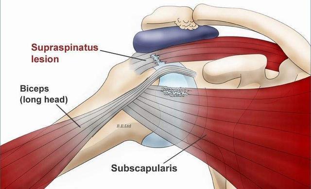 如何高效改善運動傷害復健後肌肉對稱？單側訓練與目標式訓練完整教學